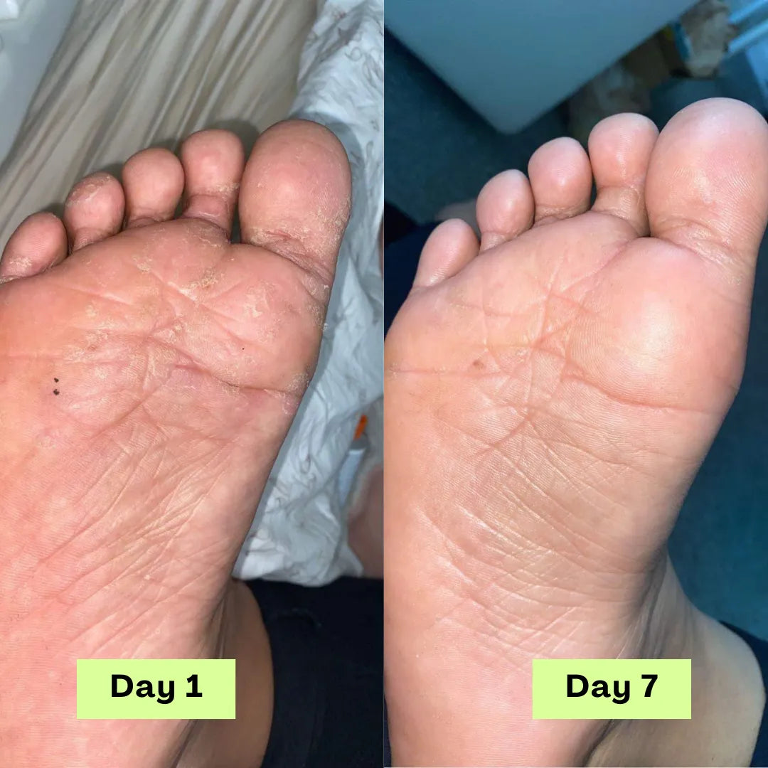 Veloura® AntiFungal Relief Soap Bar