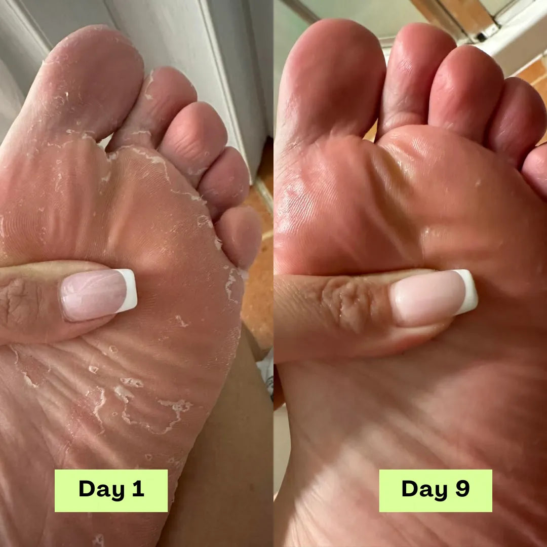 Veloura® AntiFungal Relief Soap Bar