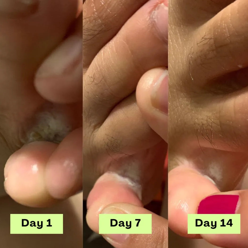 Veloura® AntiFungal Relief Soap Bar